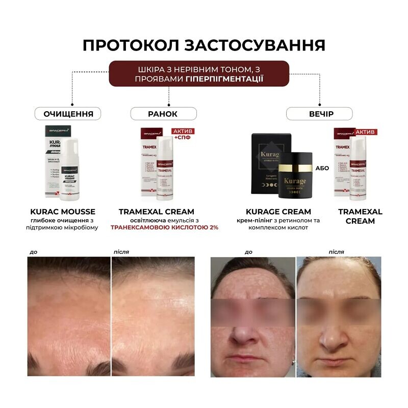 Braderm Tramexal Cream 30 мл – Освітлюючий крем проти пігментації - Зображення 2